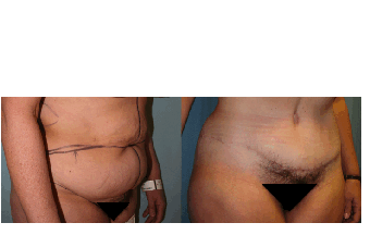 Abdominoplasty (tummy tuck) and Flank Liposuction before 401723