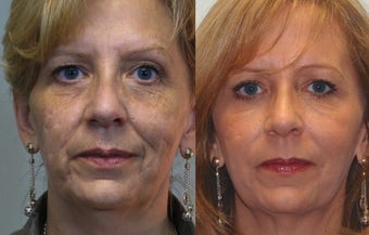 58 yo Midface filler and acne scarring before 1098253