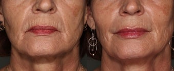 63 Year Old Female treated with Juvederm to her lips before 1018039