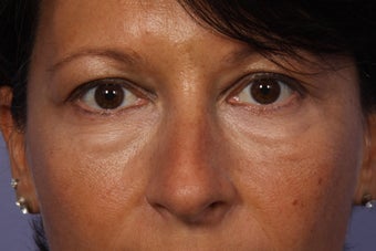 Lower Eyelid Surgery before 941139