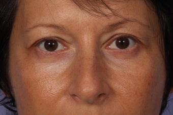 Lower Eyelid Surgery after 941139