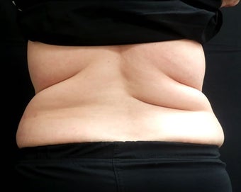 Coolsculpting on Flanks before 1148172