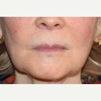 Lip Augmentation with Artefill (now called Bellafill). after 1631314