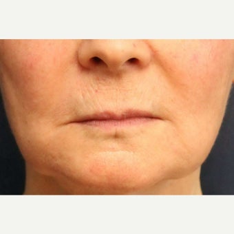 Lip Augmentation with Artefill (now called Bellafill). before 1631314