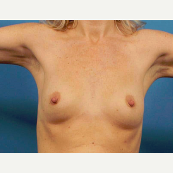 35-44 year old woman treated with Breast Implants before 3786974