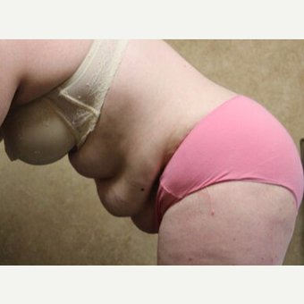 Tummy Tuck with Liposuction before 3454661