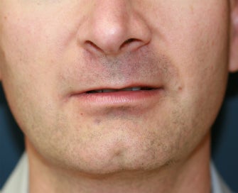 Lip Lift (permanent lip enhancement) before 1151948
