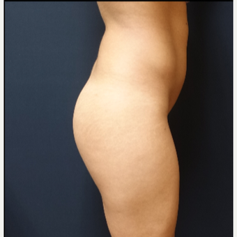 25-34 year old woman treated with 548cc Round Silicone Butt Implants for her Augmentation before 3043118