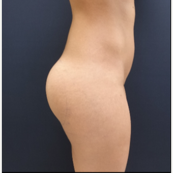 25-34 year old woman treated with 548cc Round Silicone Butt Implants for her Augmentation after 3043118