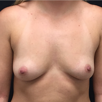 25-34 year old woman treated with Breast Augmentation before 3494015
