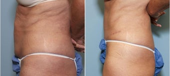 56 year old female with abdominal laxity after 718515