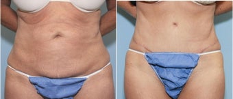 56 year old female with abdominal laxity before 718515