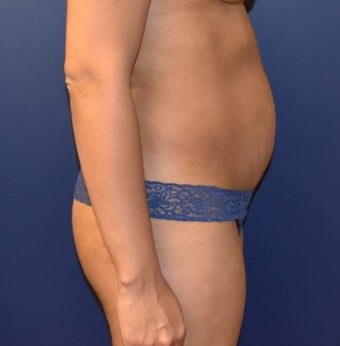 35-44 year old woman treated with Liposuction before 3348731