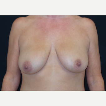 45-54 year old woman treated with Breast Lift before 3666064