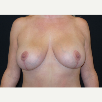 45-54 year old woman treated with Breast Lift after 3666064