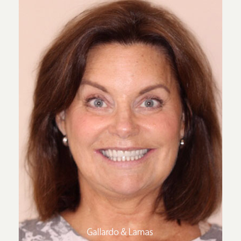 55-64 year old woman treated with All-on-4 Dental Implants after 3093802