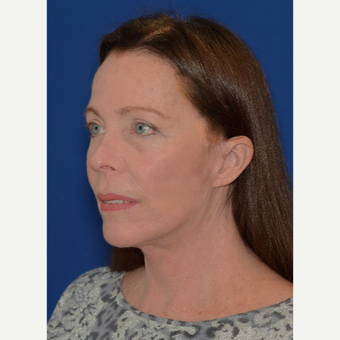 Natural results after full facial rejuvenation (face, neck, brow lift, revision upper lids)! after 3621619