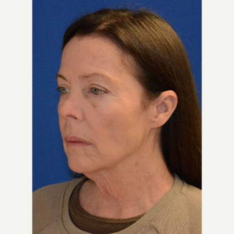 Natural results after full facial rejuvenation (face, neck, brow lift, revision upper lids)! before 3621619