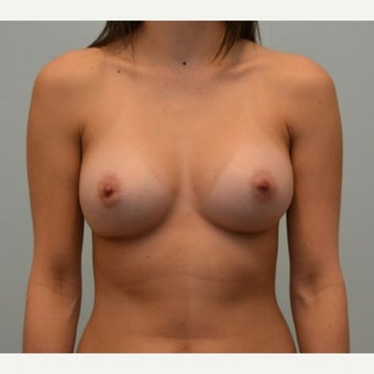 36 year old patient with Natrelle Gel Shaped 410 Implants after 1868272
