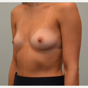 36 year old patient with Natrelle Gel Shaped 410 Implants 1868272