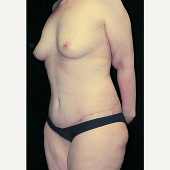 Body Contouring after Sleeve Gastrectomy after 3332785