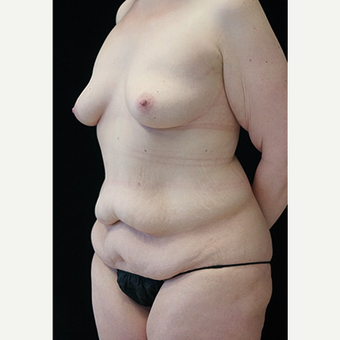 Body Contouring after Sleeve Gastrectomy before 3332785