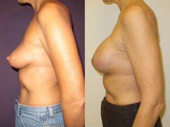 Breast Reconstruction 1032018