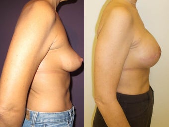 Breast Reconstruction after 1032018