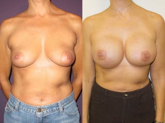 Breast Reconstruction before 1032018