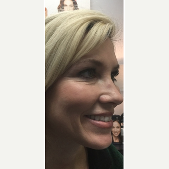 25-34 year old woman treated with Botox before 3664964