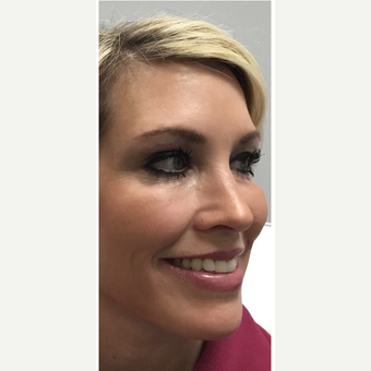 25-34 year old woman treated with Botox after 3664964