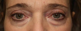 Upper and Lower Eyelids. 61 year-old patient before 1332685
