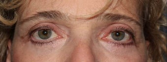 Upper and Lower Eyelids. 61 year-old patient after 1332685