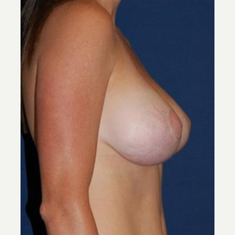 35-44 year old woman treated with Breast Lift with Implants after 3370708