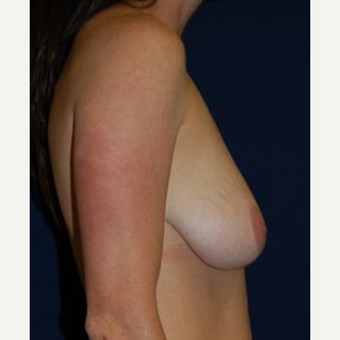 35-44 year old woman treated with Breast Lift with Implants before 3370708