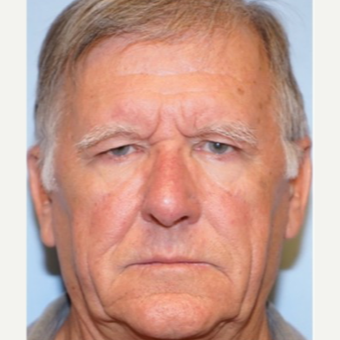 65-74 year old man treated with Brow Lift before 3727749