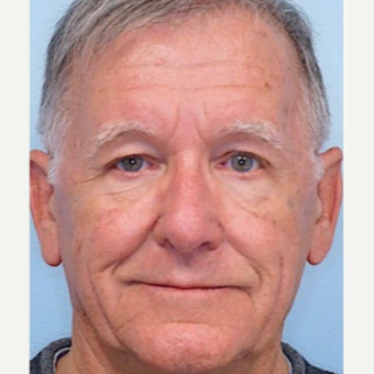 65-74 year old man treated with Brow Lift after 3727749