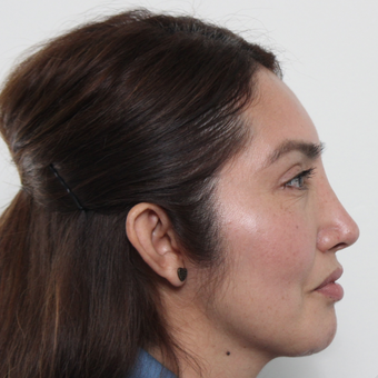 45-54 year old woman treated with Rhinoplasty after 3442527