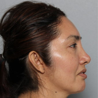 45-54 year old woman treated with Rhinoplasty before 3442527