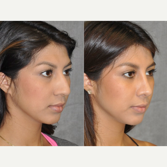 18-24 year old woman treated with Rhinoplasty before 3181390