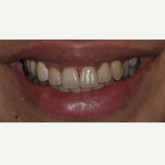 26 year old woman treated with Porcelain Veneers before 3537732