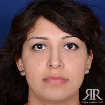 Rhinoplasty after 1357426