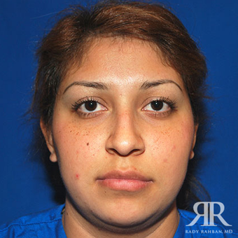 Rhinoplasty before 1357426