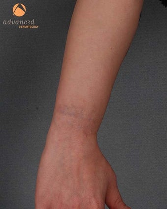 Female Treated with Q-Switched Laser (1064nm and 532nm) for the Removal of Tattoo after 1047845