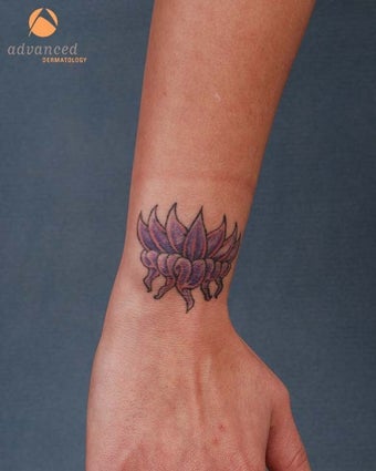 Female Treated with Q-Switched Laser (1064nm and 532nm) for the Removal of Tattoo before 1047845