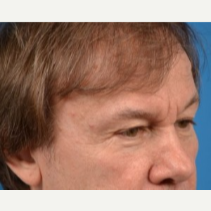 55-64 year old man treated with Brow Lift before 3388821