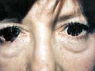 Eyelid Surgery before 973753