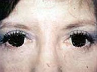 Eyelid Surgery after 973753