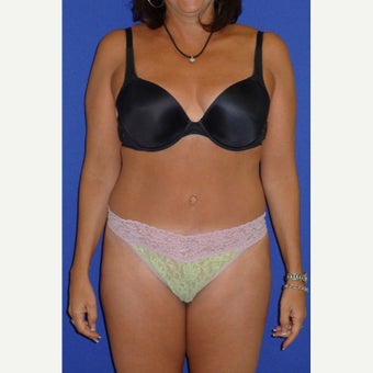 35-44 year old woman treated with Vaser Liposuction after 2257212