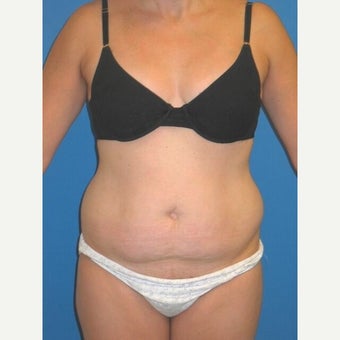 35-44 year old woman treated with Vaser Liposuction before 2257212